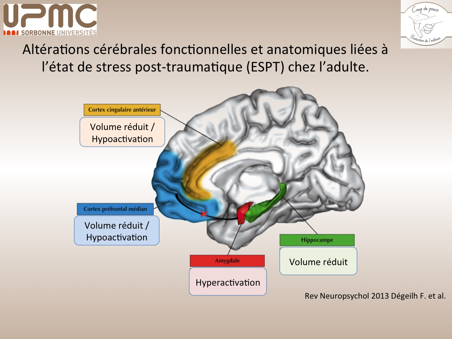 schéma des altérations cérébrales fonctionnelles et anatomiques liées à l'état de stress post-traumatique chez l'adulte